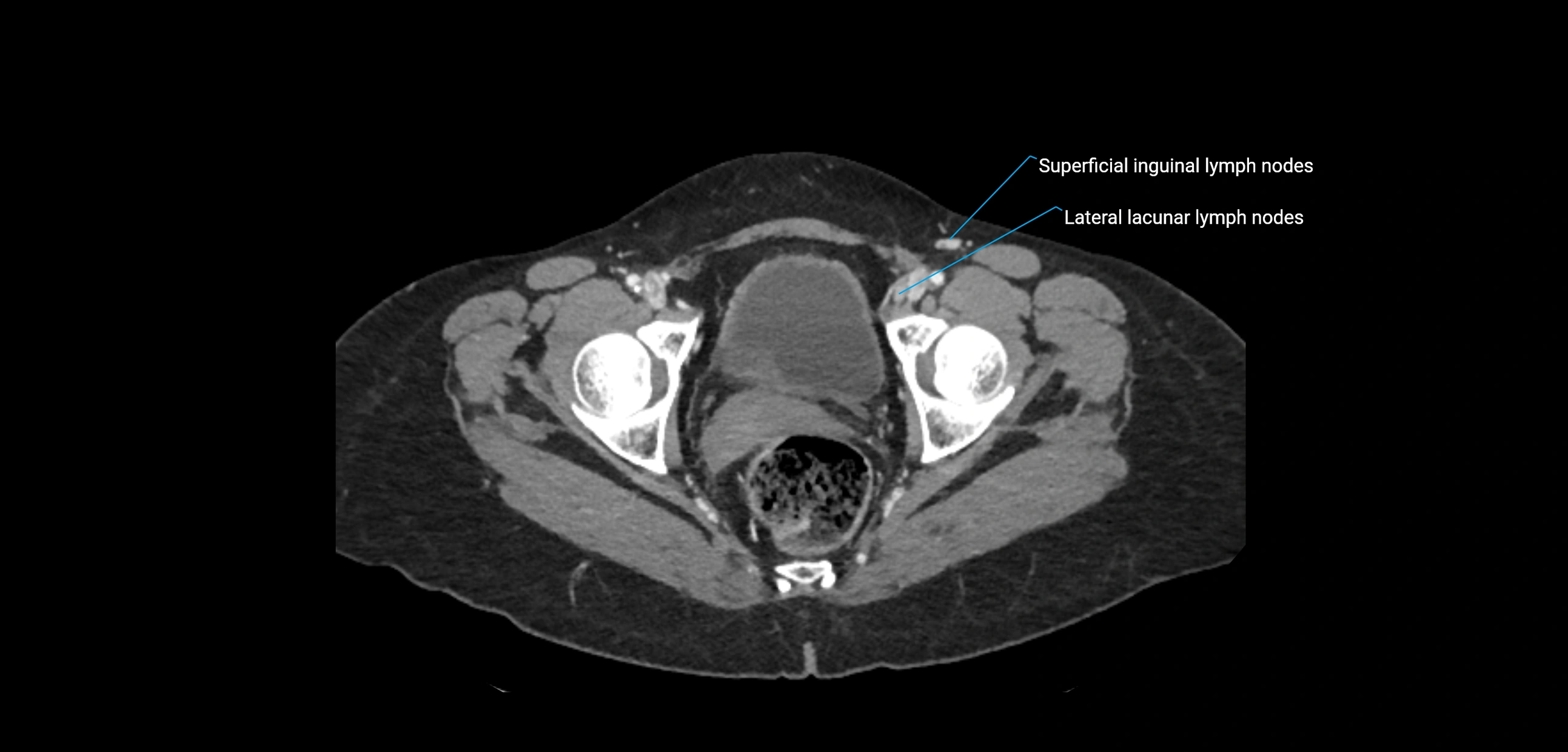 CT ct abdominal lymph nodes  axial cross sectional anatomy  enchanced radiology image -img-00002-00387.webp
